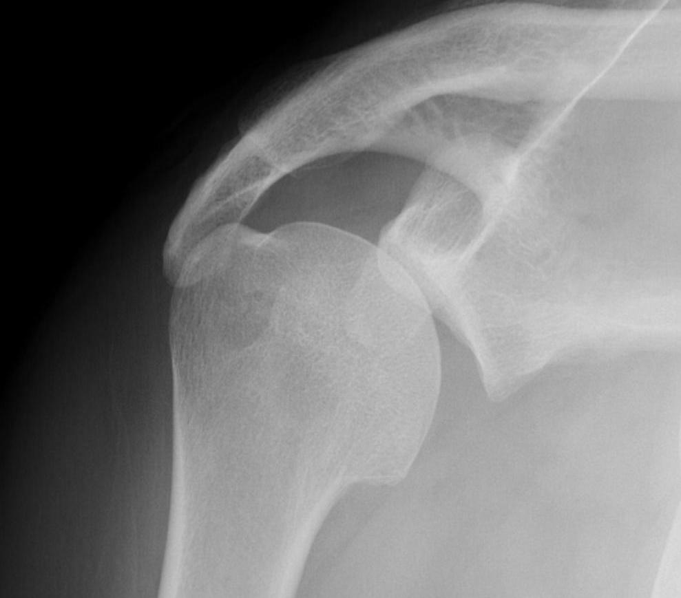 Posterior Shoulder Dislocation AP Non Concentric GHJ